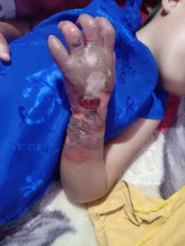 Một số kết quả của HTA dùng cho bỏng